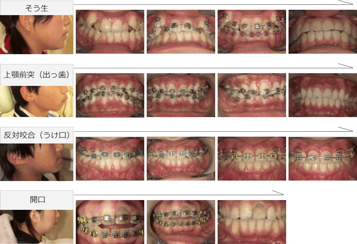 矯正治療症例